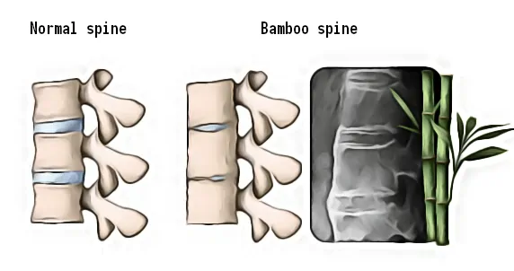 Normal and bamboo spine